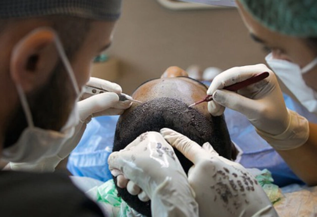 Image of DHI hair transplant procedure