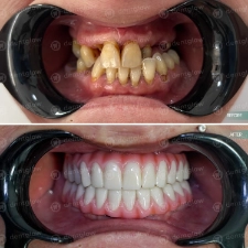 Dental work before and After photo