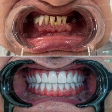 Dental work before and After photo