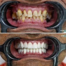 Dental work before and After photo