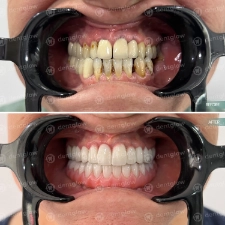Dental work before and After photo