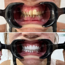 Dental work before and After photo