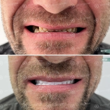 Dental work before and After photo