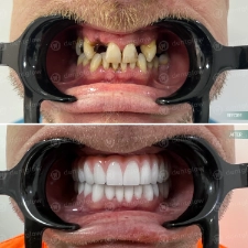 Dental work before and After photo