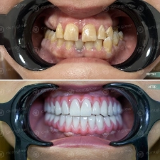 Dental work before and After photo