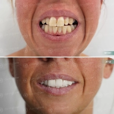 Dental work before and After photo