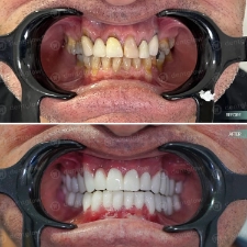 Dental work before and After photo